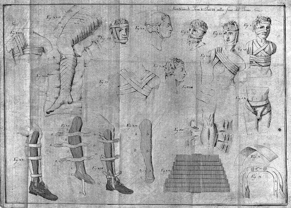 M0015621: Bandages and splints, from Bertrandi: <i>Opere</i>, 1786