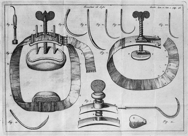 M0015628: Illustration of tourniquets, from Bertrandi: <i>Opere</i>, 1786
