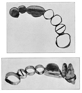 Etruscan appliance for supporting three artificial teeth.