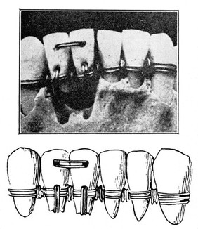 Dentistry, phoenician prosthetic appliance