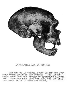 Skull of La Chapelle-aux-saints Man (Mousterian) with evidence of supposed pyorrhoea alveolaris