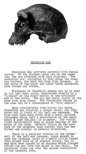 view Skull of Thodesian Man showing evidences of disease as described in accompanying text