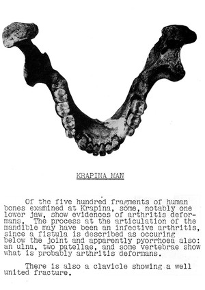 view Diseased lower jawbone from Krapina