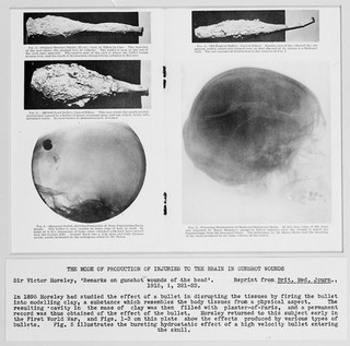 Sir Victor Horsley, 'Remarks on gunshot wounds of the head'.