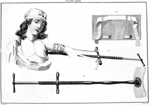 Instrument for correcting dislocations, 18th century.