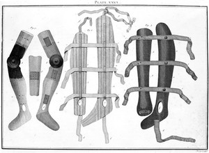 view Surgical splints, 18th century.