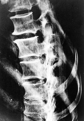 R. Moodie "Studies of mummies": x-ray of spine