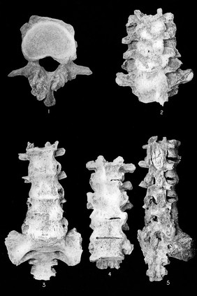 Vertebrae from a skeleton showing spondylitis deformans