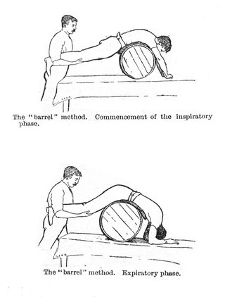M0017194: Illustration of a method of artificial respiration by rolling a man prone on a barrel
