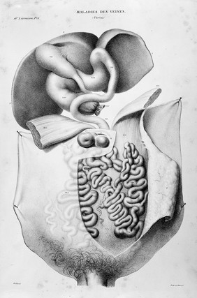Anatomie pathologique du corps humain, ou descriptions ... des diverses altérations morbides dont le corps humain est susceptible / [J. Cruveilhier].