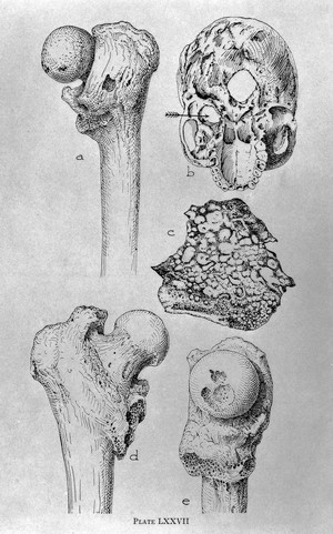 view Pathological conditions found in bones of Ancient Egyptians.