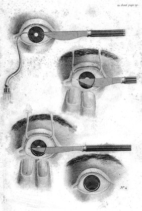 Operation for cataract, Sir James Earle