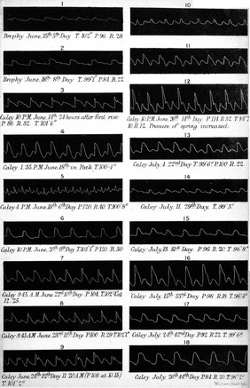 On the treatment of hyperpyrexia as illustrated in acute articular rheumatism by means of the external application of cold / by Wilson Fox.