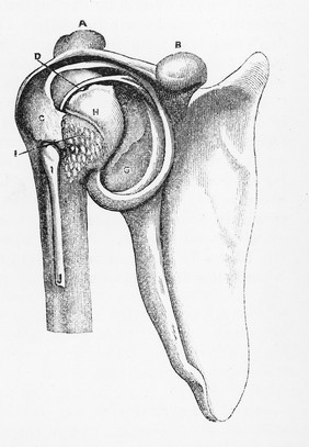 Chronic rheumatic arthritis. Post-mortem appearance of the shoulder-joint of a patient, who had been totally disabled by the condition of his joints. The elevation of the humerus is particularly referred to.