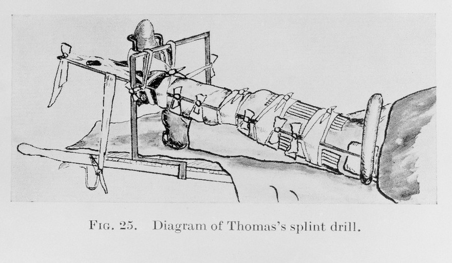 M0019190: Illustration of Thomas's splint drill