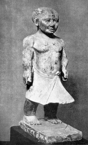 The Achondroplastic dwarf, Chnoum-hotep. From the lime-stone statuette found at Saqqarah and now in the Cairo Museum