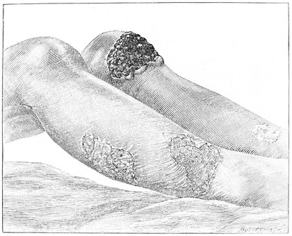 Cancer arising in patch of psoriasis, Bland-Sutton, 1922