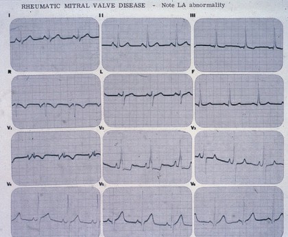 Rheumatic mitral valve disease