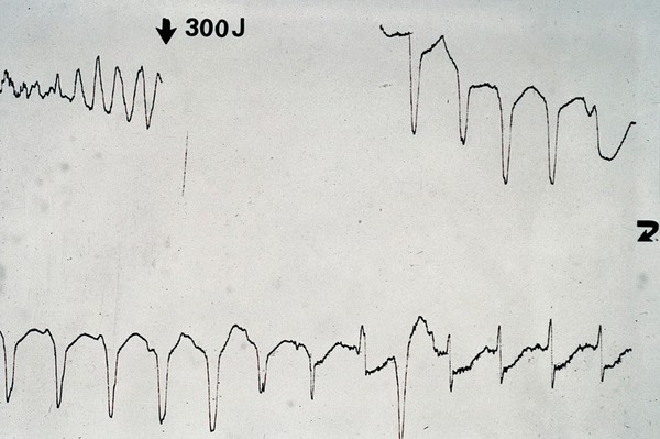 Defibrillation of ventricular fibrillation