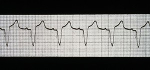view Pacing, atrial synchronal ventricular