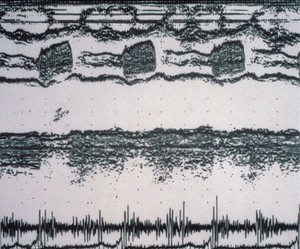 view Atrioventricular endocarditis