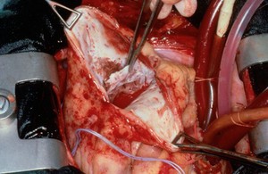 view Open heart surgery