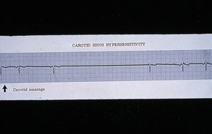 view Carotid sinus hypersensitivity