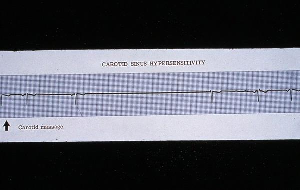 Carotid sinus hypersensitivity