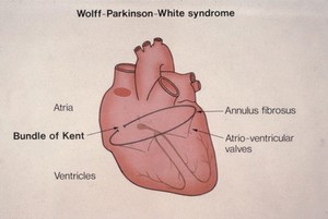 view Wolff-Parkinson-White syndrome