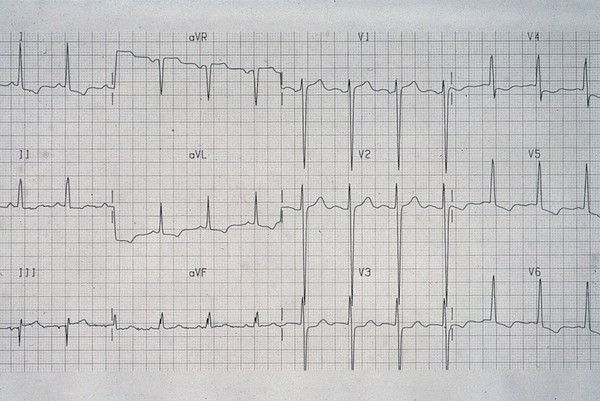 Hypertrophy, left ventricular