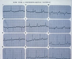 view Wolff-Parkinson-White syndrome