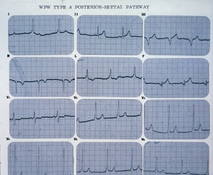 Wolff-Parkinson-White syndrome