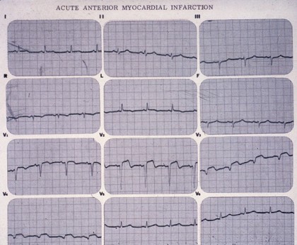 Myocardial infarction, acute anterior