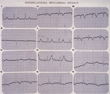 Myocardial infarction, inferiolateral