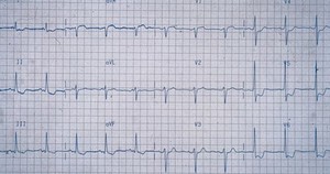 view ECG trace showing unstable angina pectoris. This is the symptom of paroxysmal pain consequent to myocardial ischaemia, usually of distinctive character, location and radiation. It is thought to be provoked by a transient stressful situation during which the oxygen requirements of the myocardium exceed that supplied by the coronary circulation.