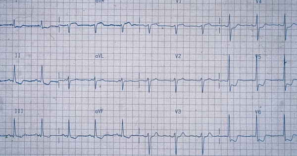 ECG trace showing unstable angina pectoris. This is the symptom of paroxysmal pain consequent to myocardial ischaemia, usually of distinctive character, location and radiation. It is thought to be provoked by a transient stressful situation during which the oxygen requirements of the myocardium exceed that supplied by the coronary circulation.