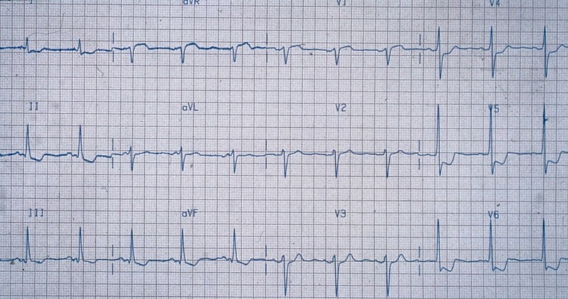 unstable angina ecg