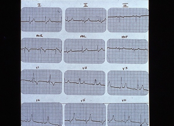 Right bundle branch block