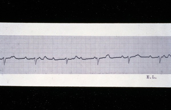 Heart block, complete