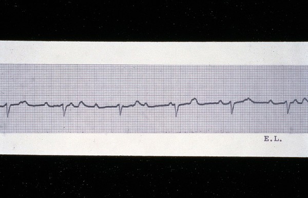 Heart block, complete