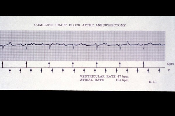 Heart block, complete, after aneurysectomy