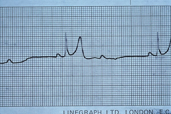 Wenckebach phenomenon 2:1 atrioventricular block