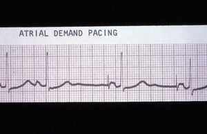 view Pacing, atrial demand