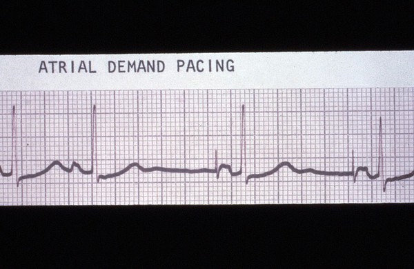 Pacing, atrial demand