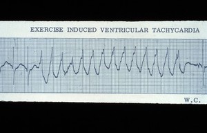 view Tachycardia ventricular, exercise induced