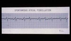 view Fibrillation, spontaneous atrial