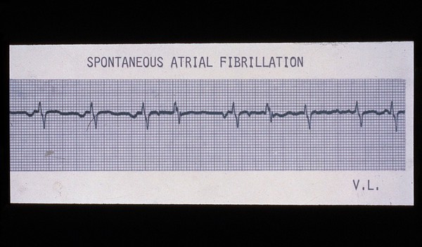 Fibrillation, spontaneous atrial