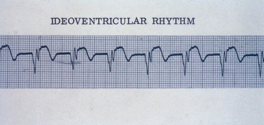 Ideoventricular rhythm