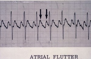 view Flutter, atrial