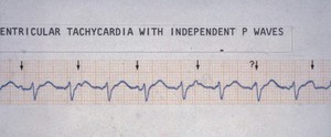 view Tachycardia ventricular, with independent P waves